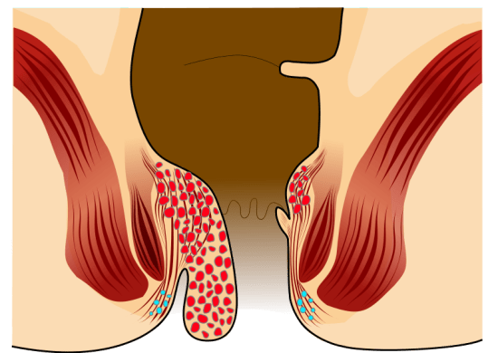 Colite ulcerosa vs grappoli in forma tabulare