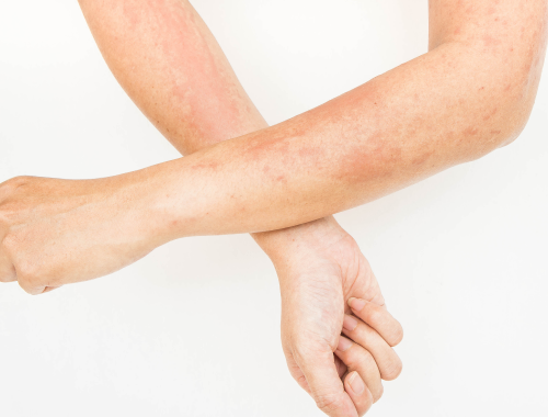 Differenza tra un rash Lupus e rosacea